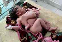 В Индии родился ребёнок с тремя руками и четырьмя ногами