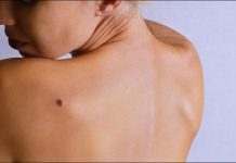 В Украине растёт количество заболевших меланомой