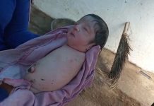 В Индии вследствие мутации родился ребёнок без ног и без рук