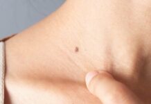 Краще не варто: що буде, якщо здерти родимку