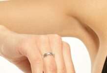 Чим краще обробити попрілості влітку: головні засоби