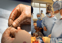 Серце довелося повністю зупинити: у Дніпрі провели унікальну операцію важкопораненому військовому