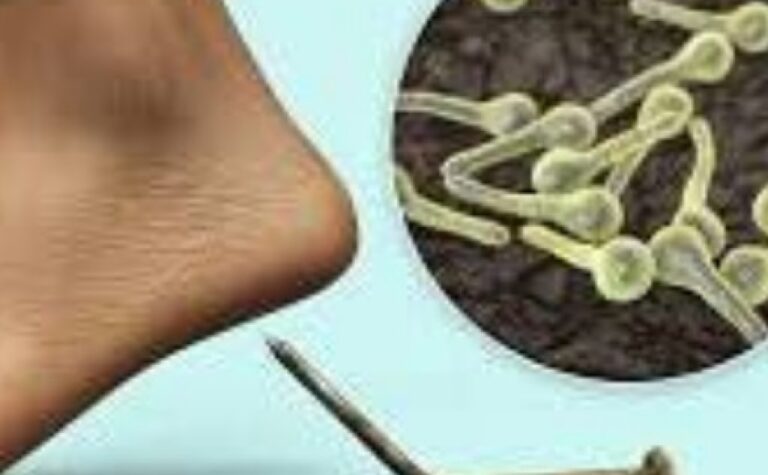 На Дніпропетровщині від правця помер 14-річний хлопець