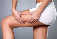 Топ-5 способів, які допоможуть позбутися розтяжок на шкірі