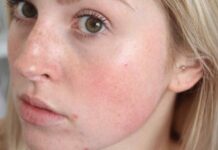 Обличчя раптово червоніє? На це є 6 причин – і це не завжди алергія
